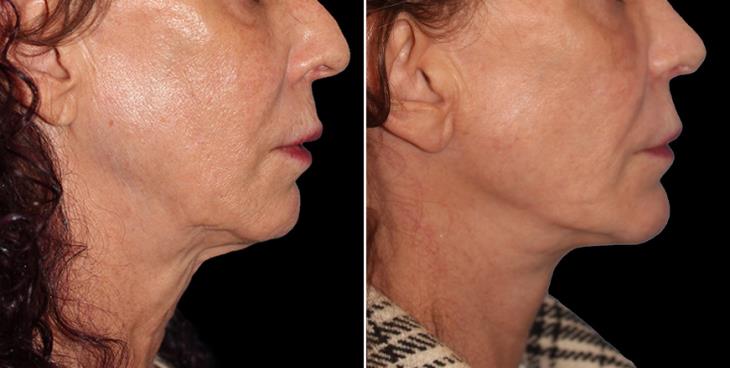 Atlanta Neck Lift Surgery Results Right Side View