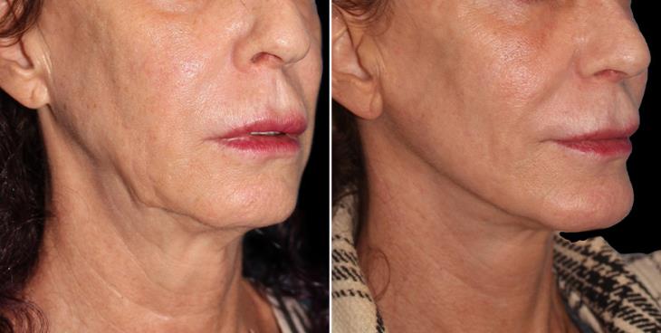 Atlanta Neck Lift Surgery Results ¾ Right View