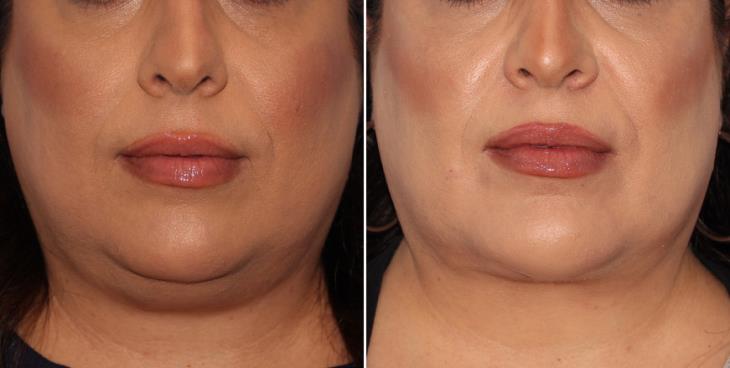 Results Of Neck Lift Surgery Atlanta GA