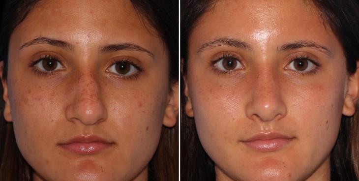 Before & After Rhinoplasty Cumming GA