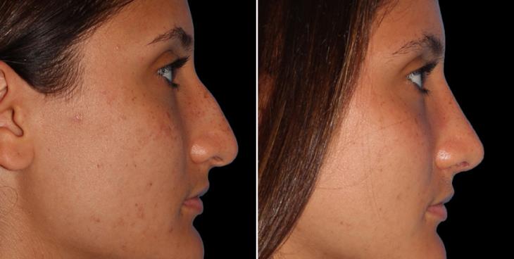 Before And After Rhinoplasty Cumming GA