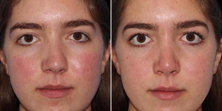 Rhinoplasty Before & After Cumming GA