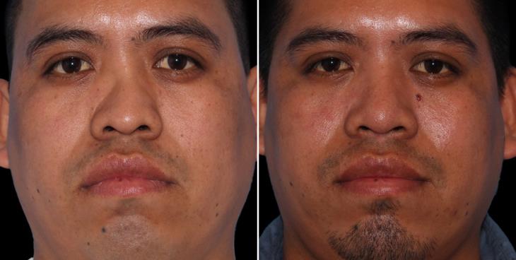 Before & After Rhinoplasty Surgery Cumming GA