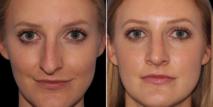 Rhinoplasty Surgery Before & After Cumming GA