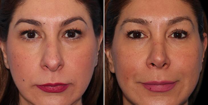 Nose Surgery Results Cumming GA