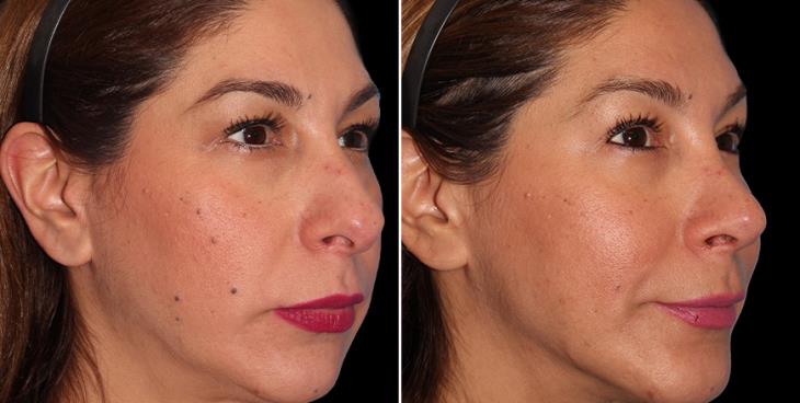 Results Of Nose Surgery Cumming GA