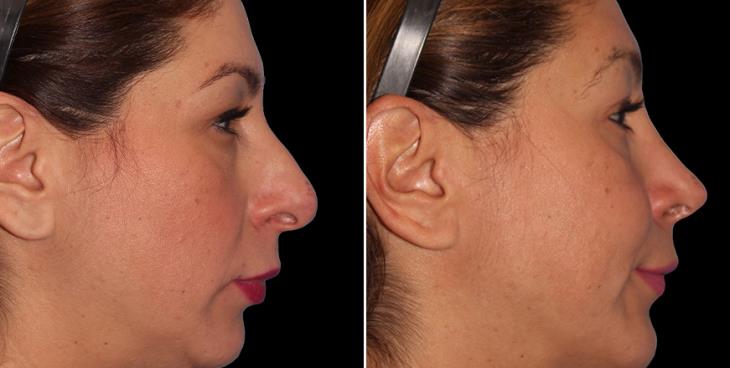 Before And After Nose Surgery Cumming GA