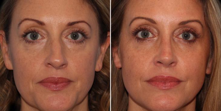Nose Surgery Before And After Cumming GA