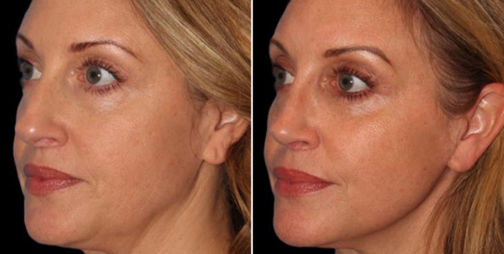 Before & After Nose Surgery Cumming GA