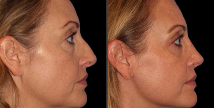 Nose Surgery Before & After Cumming GA