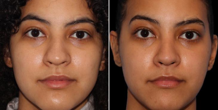 Rhinoplasty Results Cumming Georgia