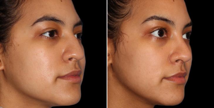 Results Of Rhinoplasty Cumming Georgia