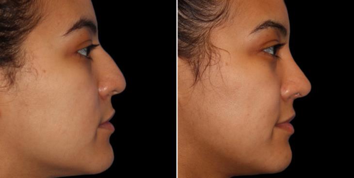 Rhinoplasty Surgery Results Cumming Georgia
