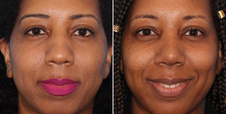 Results Of Rhinoplasty Surgery Cumming Georgia
