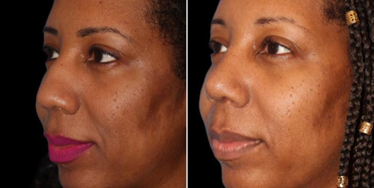  Before & AfterRhinoplasty Cumming Georgia
