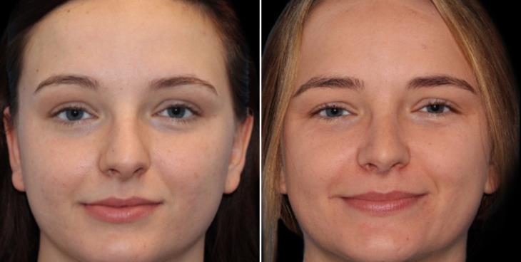Before And After Rhinoplasty Surgery Cumming Georgia
