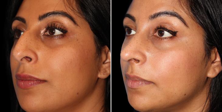 Before & After Nose Surgery Cumming Georgia
