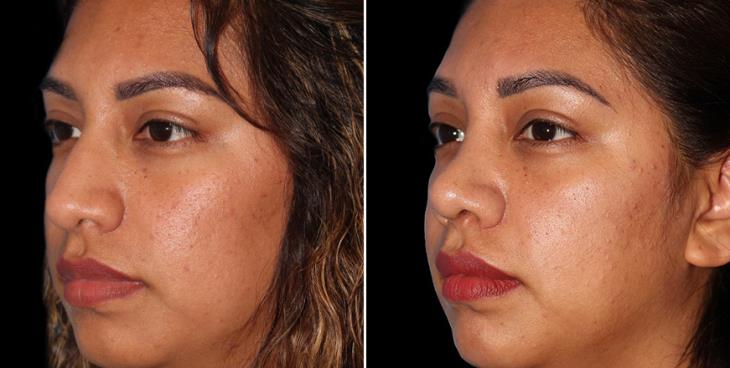 Rhinoplasty Surgery Results Marietta