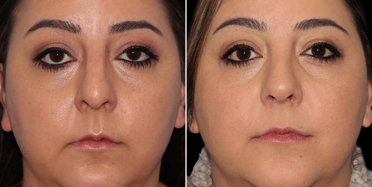 Results Of Rhinoplasty Surgery Marietta