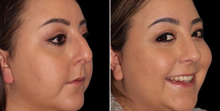 Before & After Rhinoplasty Marietta