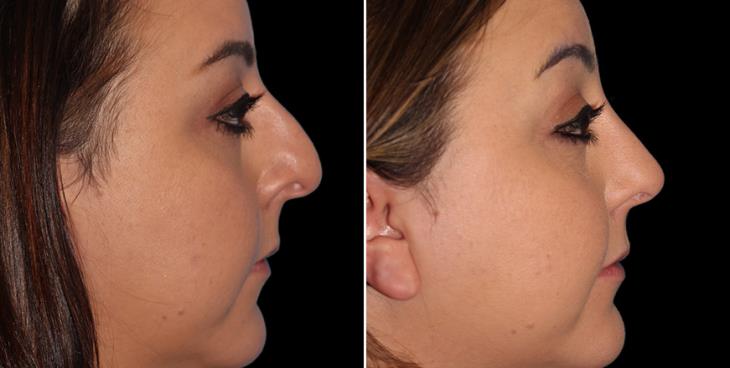 Before And After Rhinoplasty Marietta