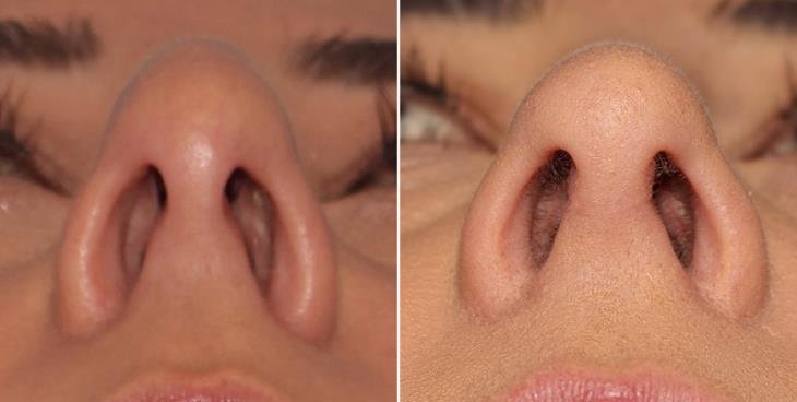 Rhinoplasty Before & After Marietta