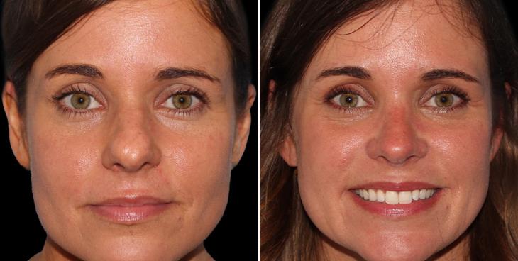Rhinoplasty Before And After Marietta