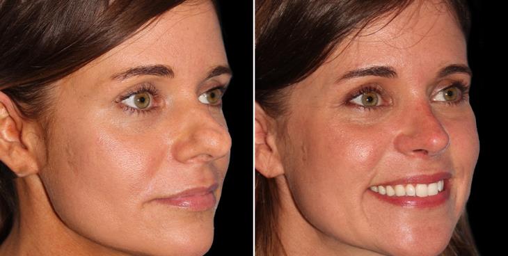 Before & After Rhinoplasty Surgery Marietta