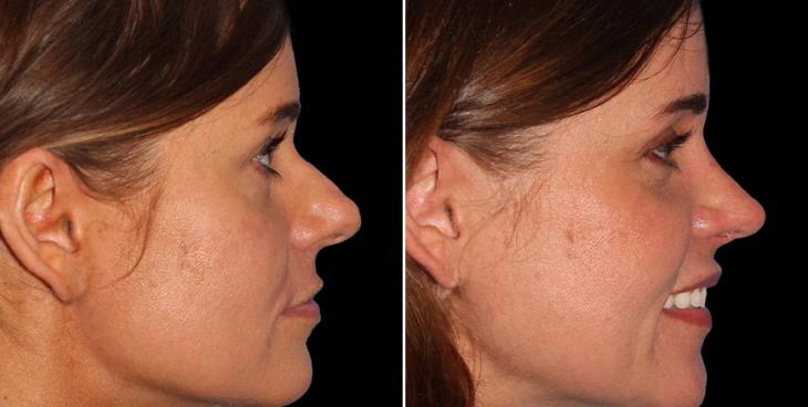 Before And After Rhinoplasty Surgery Marietta