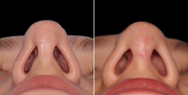 Before And After Nose Surgery Marietta