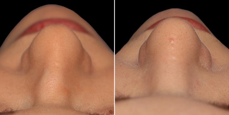 Rhinoplasty Results Marietta GA