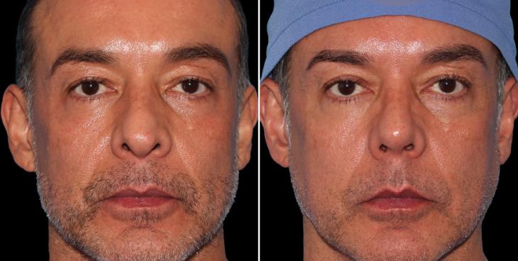 Results Of Rhinoplasty Marietta GA