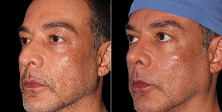 Rhinoplasty Surgery Results Marietta GA