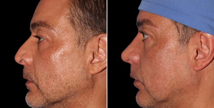 Results Of Rhinoplasty Surgery Marietta GA