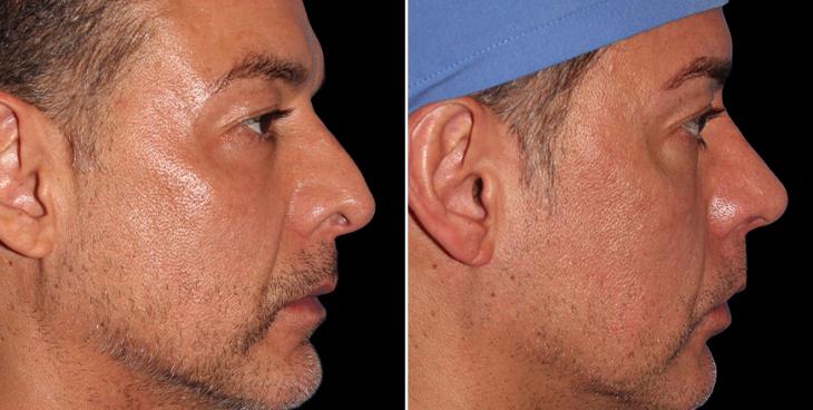 Before & After Rhinoplasty Marietta GA