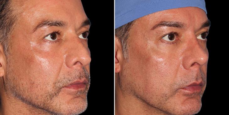 Before And After Rhinoplasty Marietta GA