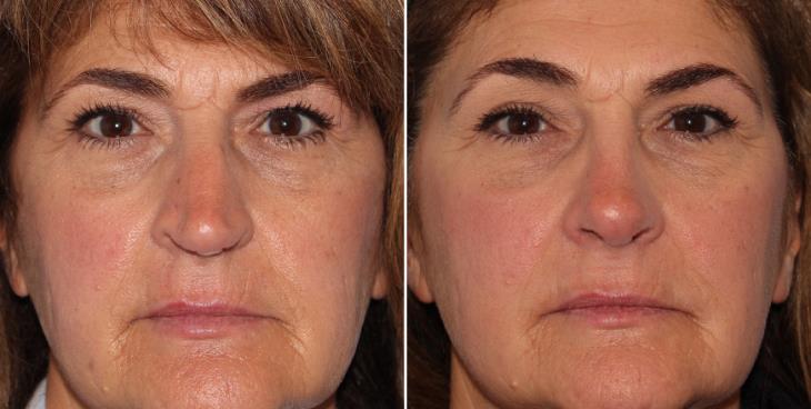 Rhinoplasty Before And After Marietta GA