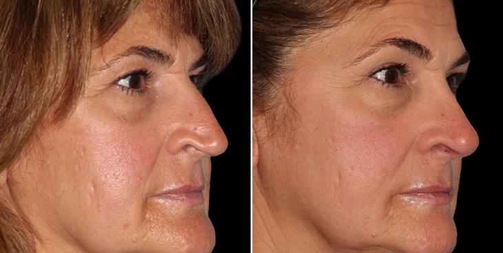Before & After Rhinoplasty Surgery Marietta GA