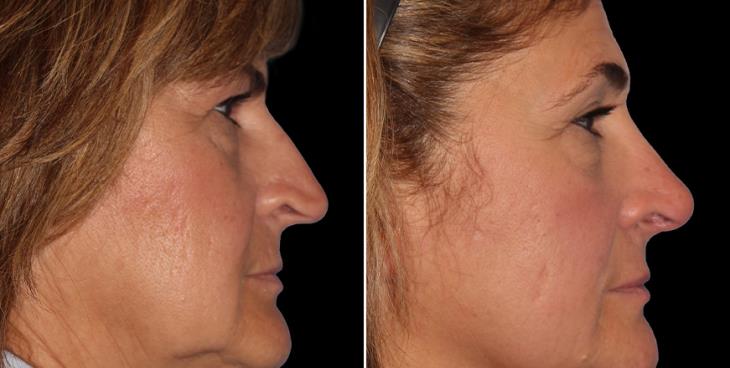 Before And After Rhinoplasty Surgery Marietta GA