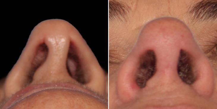 Rhinoplasty Surgery Before & After Marietta GA