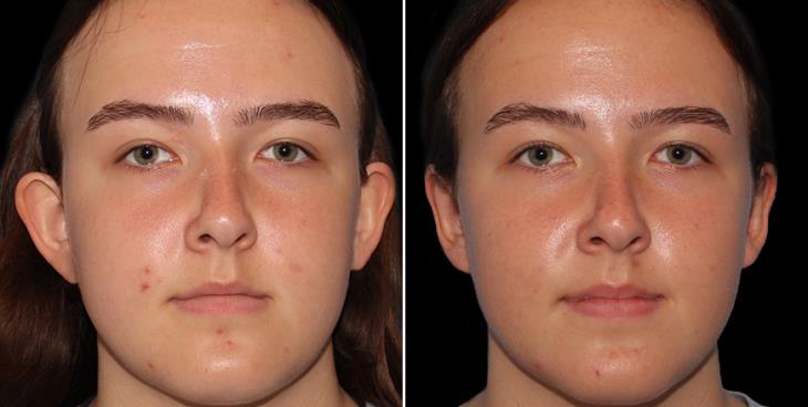 Otoplasty Results Atlanta GA