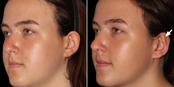 Ear Reduction Surgery Results Atlanta ¾ Left View