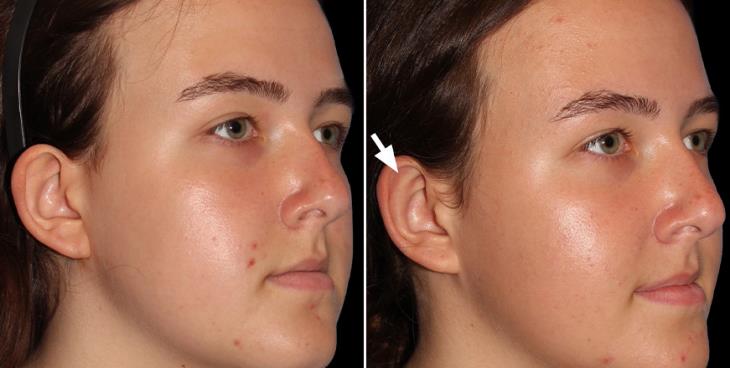 Ear Reduction Surgery Results Atlanta ¾ Right View