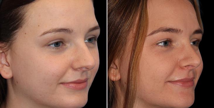 Rhinoplasty Surgery Before & After Cumming Georgia