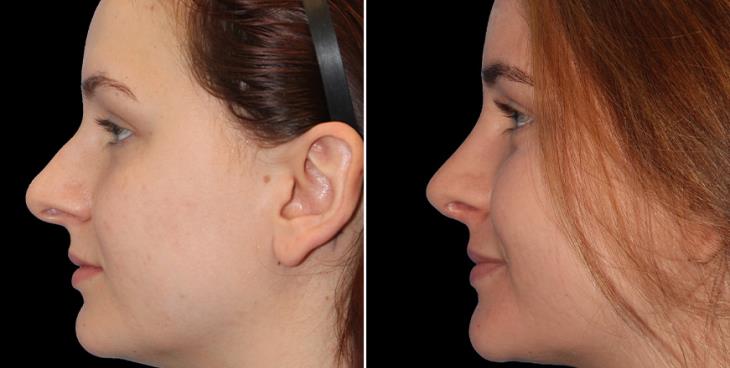 Nose Surgery Results Cumming Georgia