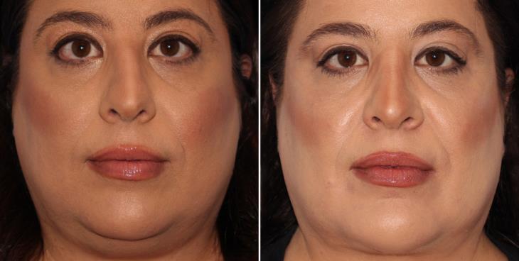 Rhinoplasty Surgery Before And After Marietta GA