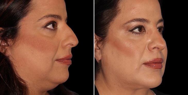 Nose Surgery Results Marietta GA