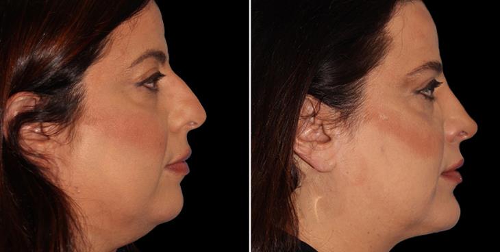 Results Of Nose Surgery Marietta GA