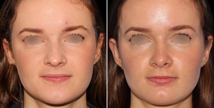 Before And After Nose Surgery Marietta GA