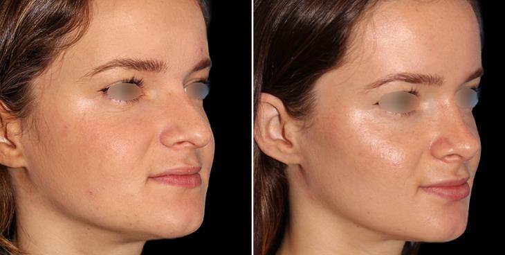 Nose Surgery Before And After Marietta GA